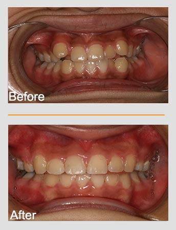 Comparison of teeth: Before, crowded and misaligned; After, straightened and aligned.