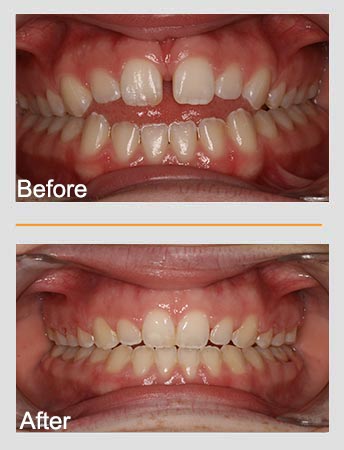 Before and after images of teeth. Top: Before, has gap. Bottom: After, teeth aligned.