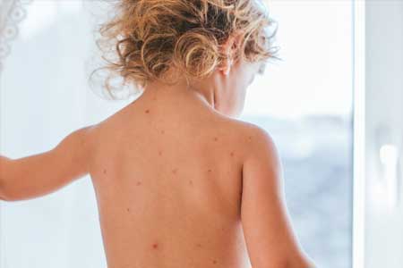 Dermatology — Kid Skin Problem in Bethpage, NY