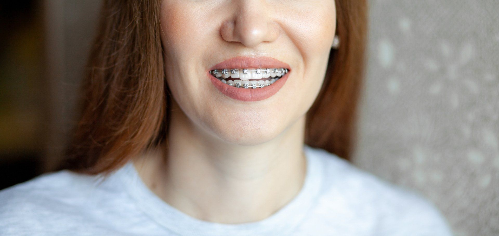 Woman with Braces — Caldwell, ID — Webster Orthodontics