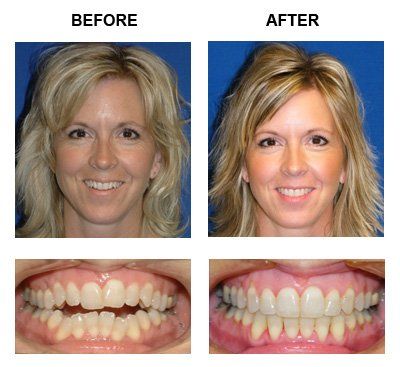Patient One Before and After — Caldwell, ID — Webster Orthodontics