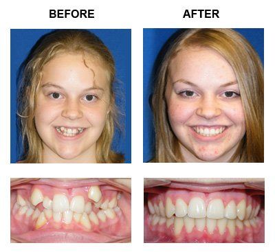 Patient Three Before and After — Caldwell, ID — Webster Orthodontics