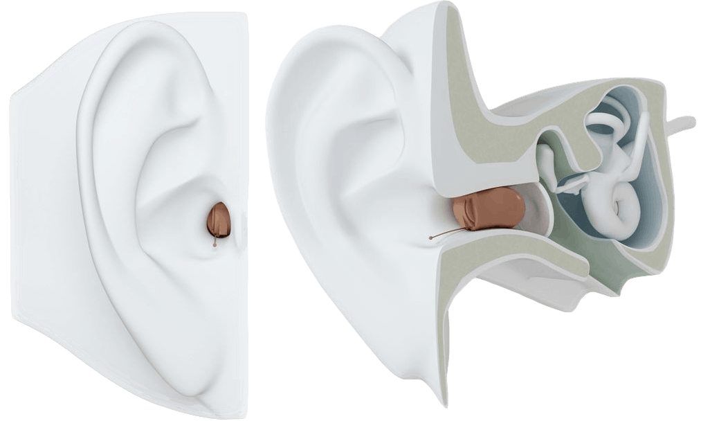 ReSound Invisible In the Ear Canal (IIC) Hearnig Aid