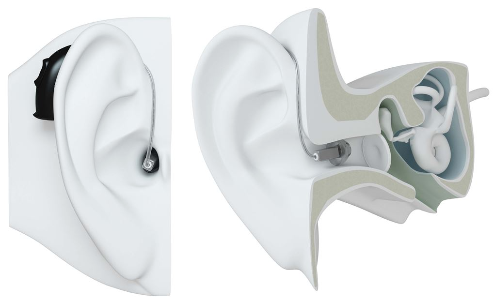 ReSound Reciver in Canal (RIC) Hearing Aid