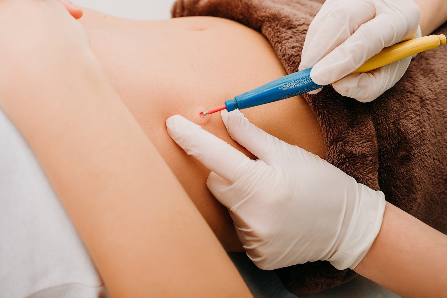 DIATERMOCOAUGULAZIONE