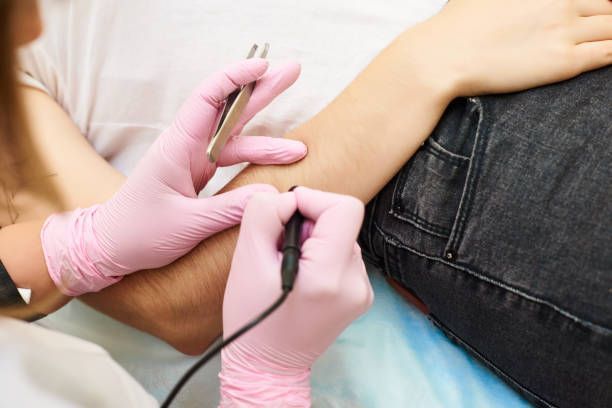 a man is getting an electrolysis treatment on his arms by an electrologist wearing pink gloves using tweezers and an electrolyzer machine