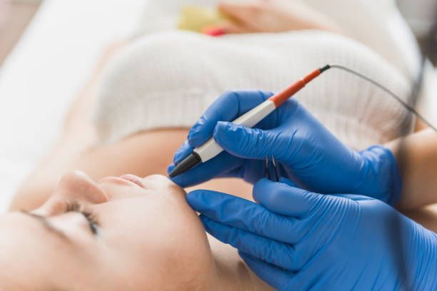 A woman is getting an electrolysis treatment on her face by an electrologist while wearing blue gloves