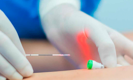 Endovenous Laser Therapy Procedure
