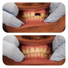 Dentures 2