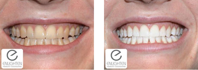 Elighten teeth whitening