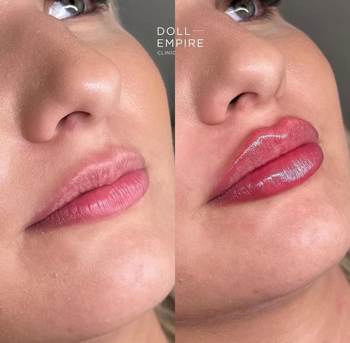 A Close-Up View of A Woman's Lips Russian  Filler— Doll Empire Clinic in Mermaid Beach, QLD