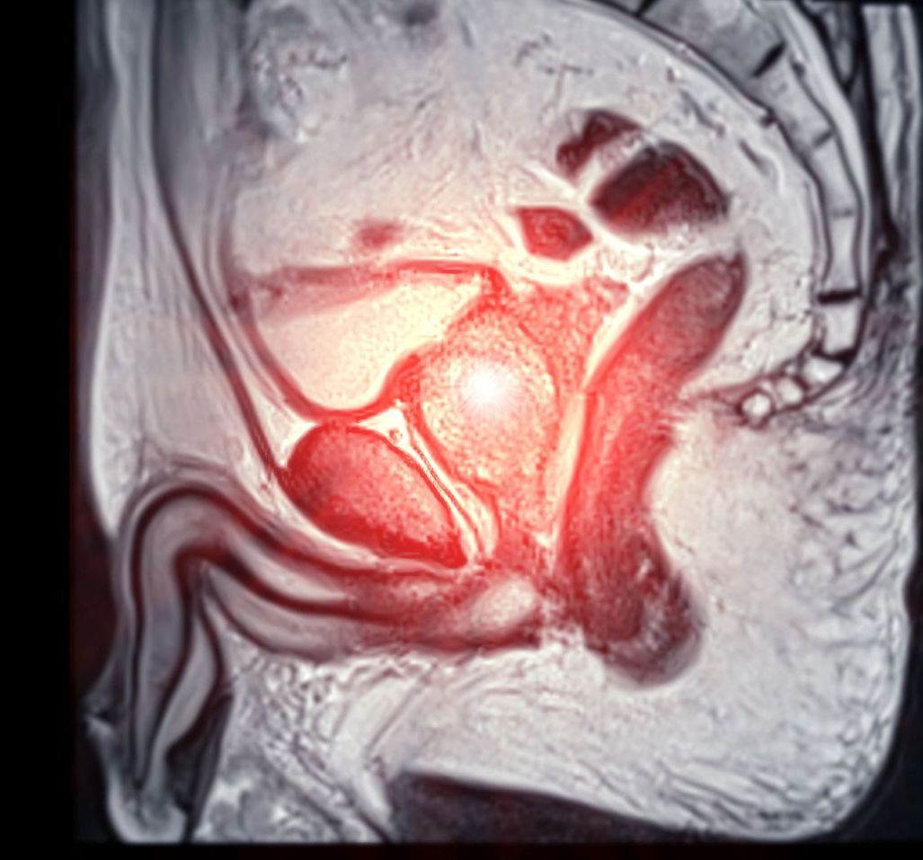 Imagem de raio x demonstrando câncer de próstata