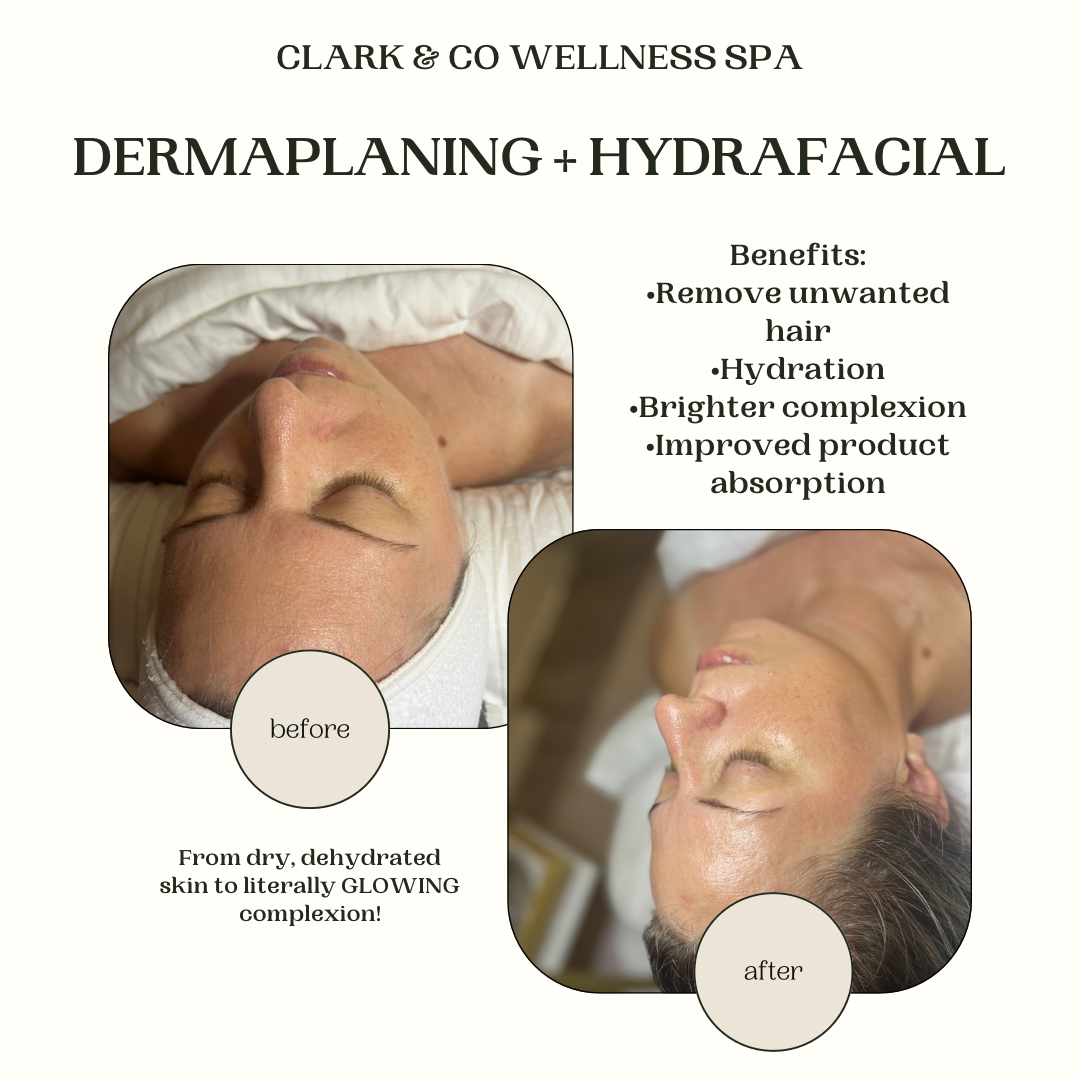 A before and after photo of a woman getting a dermaplaning and hydrafacial treatment.