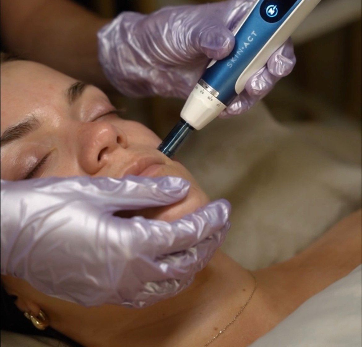 Person receiving facial treatment with a SkinPen device. Gloved hands holding the pen; close up of face.
