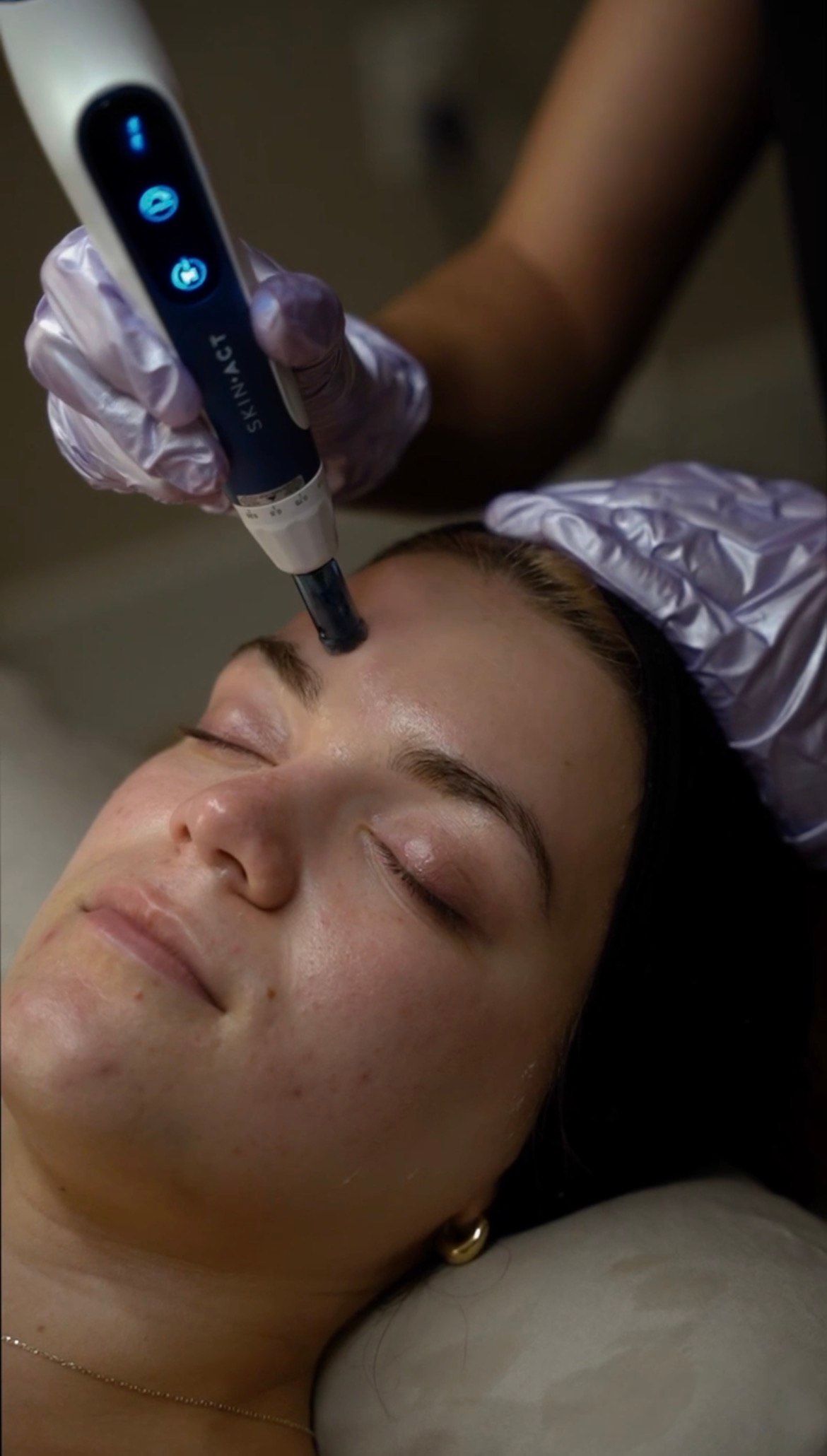 Woman receiving micro-needling treatment on her forehead; the technician wears gloves.