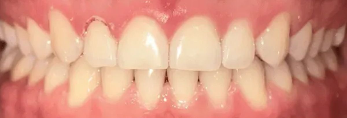Close-up of a person's upper and lower teeth, showing a smile with bright, straight teeth and healthy gums.