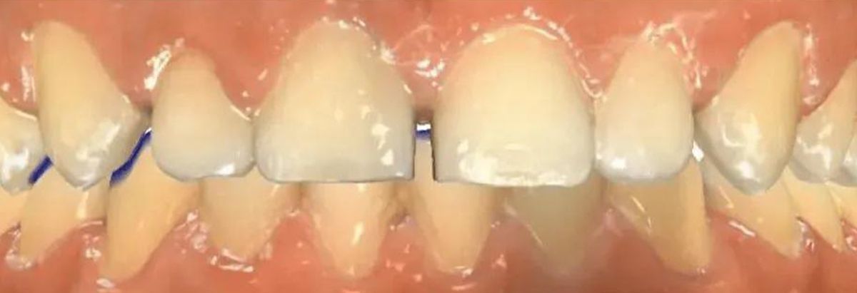 A close-up view of a person's upper and lower teeth, showing a small gap between the two front central incisors.