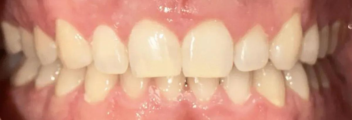 A close-up view of a person's upper and lower teeth showing a slightly misaligned bite.