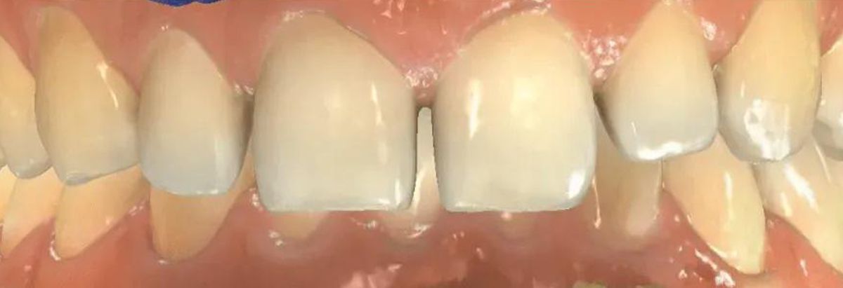 Close-up view of two front teeth featuring dental crowns, showing their shape, shade, and alignment within the gum line.