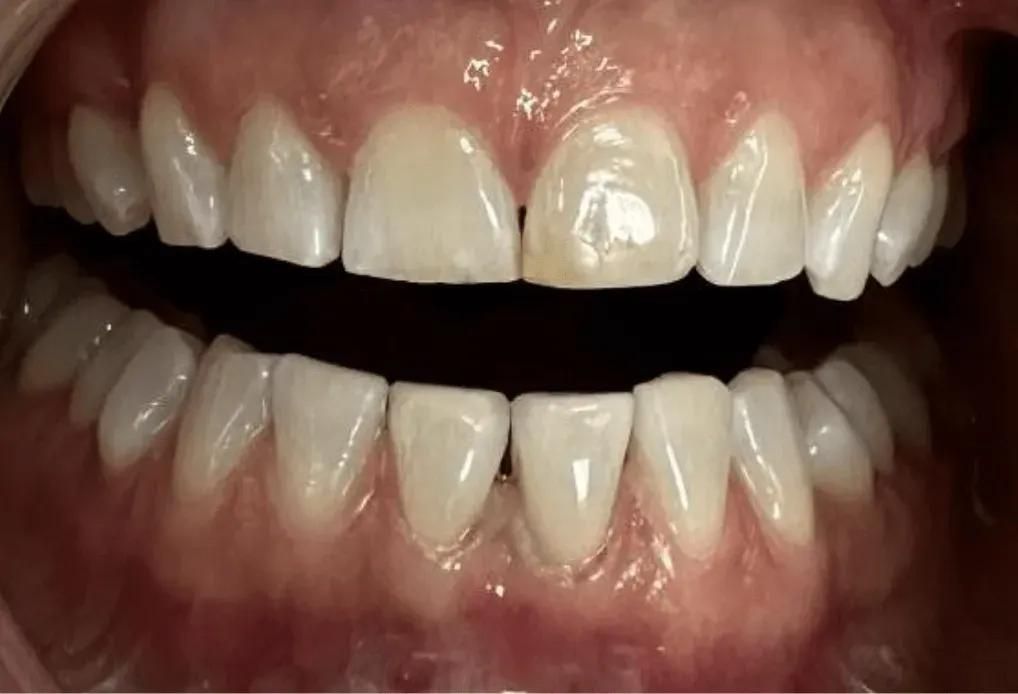 A close-up view of a person's upper and lower teeth, showing healthy gums and a slight yellow discoloration on one front tooth.