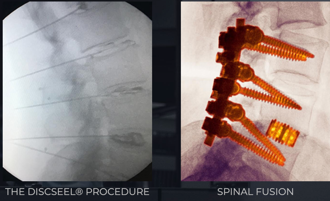 a picture of a discectomy procedure and a picture of a spinal fusion