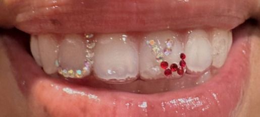 Close-up of mouth with bedazzled teeth. Rhinestones and red jewels adorn the front teeth.
