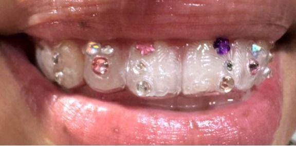 Close-up of teeth decorated with sparkly gems, with full pink lips visible.