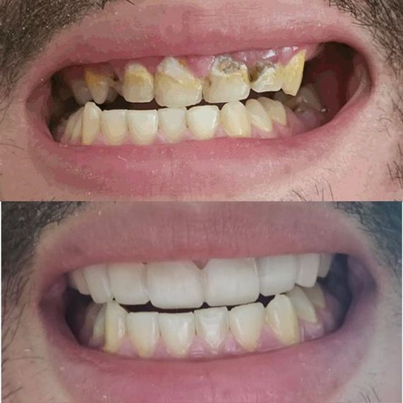 Before and after of mouth with decayed teeth, followed by bright white veneers.