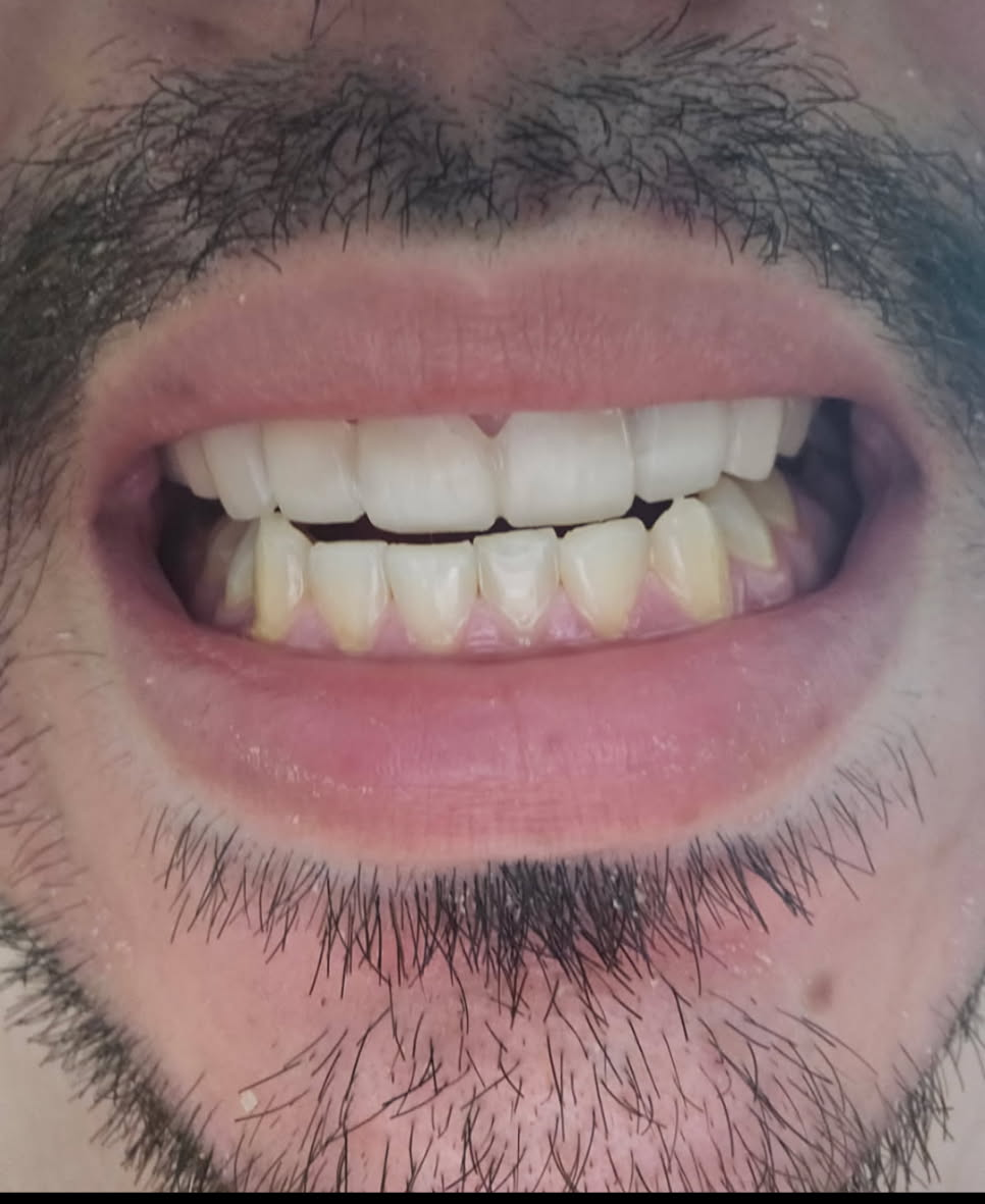 Close-up of a man's mouth; white top teeth and yellowed bottom teeth; dark facial hair; open mouth.