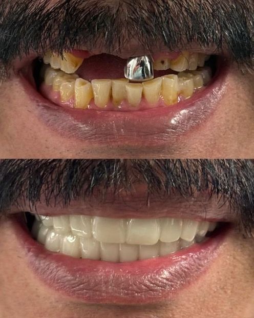 Before and after photos: Yellowed teeth and missing tooth replaced with bright white veneers.