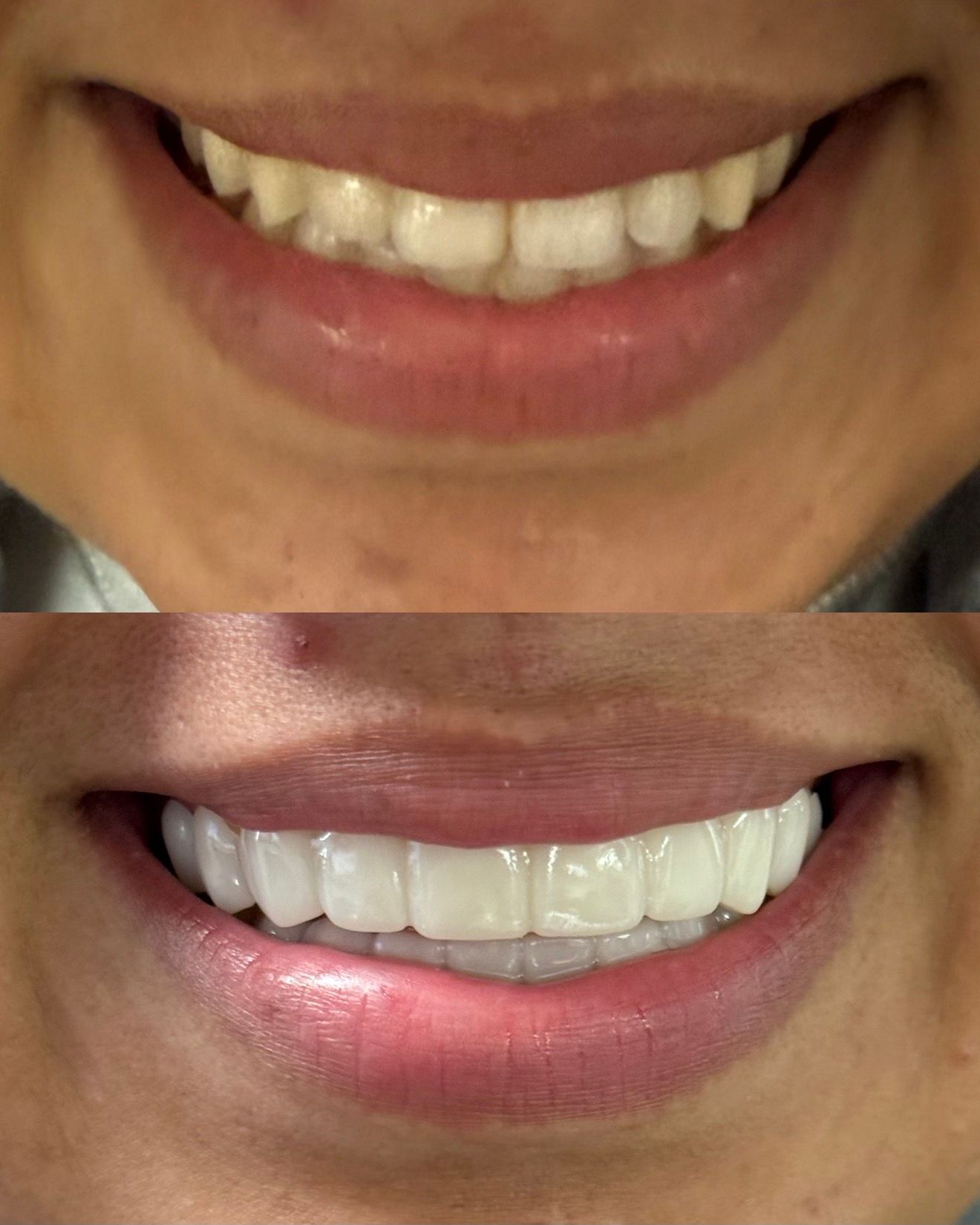 Top: Before and bottom: After dental teeth whitening; a smiling woman shows brighter teeth.