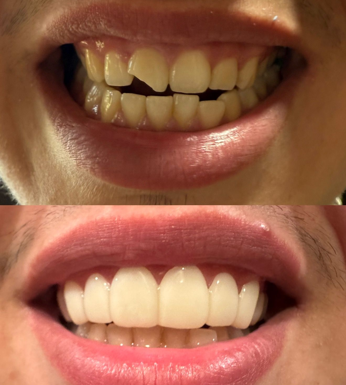 Before and after photos of a person's teeth. Top shows yellowed, cracked teeth. Bottom shows bright, white teeth.