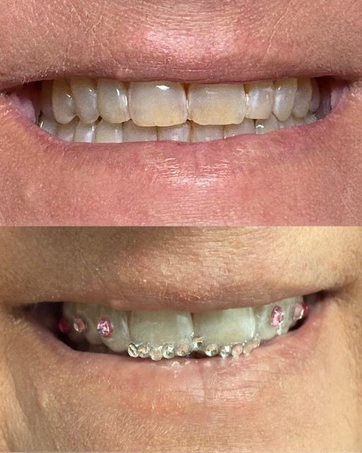 Top: woman's smile with yellowed teeth. Bottom: same smile with clear braces and pink accents.