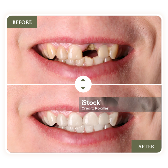 Before and after comparison: damaged teeth replaced with bright white teeth, showing a smile.