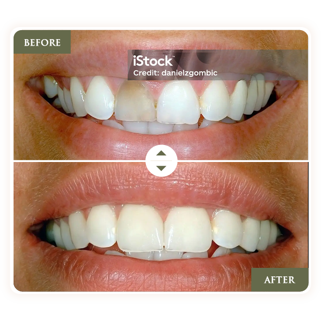 Before-and-after of teeth. Yellowish tooth replaced with white tooth, smile brightened.