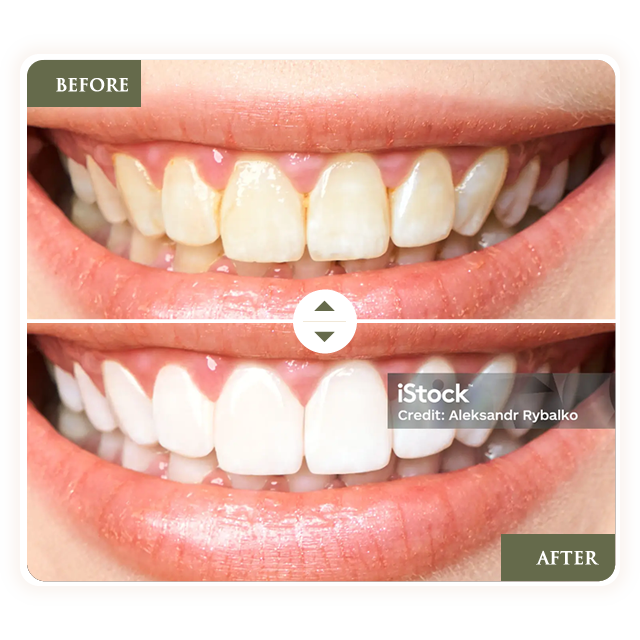 Comparison of teeth before and after whitening treatment, showing a brightened smile.