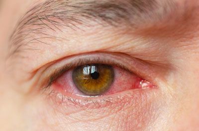 conjuntivitis, membrana transparente, globo ocular, conjuntiva, proteger los ojos, inflama la conjun