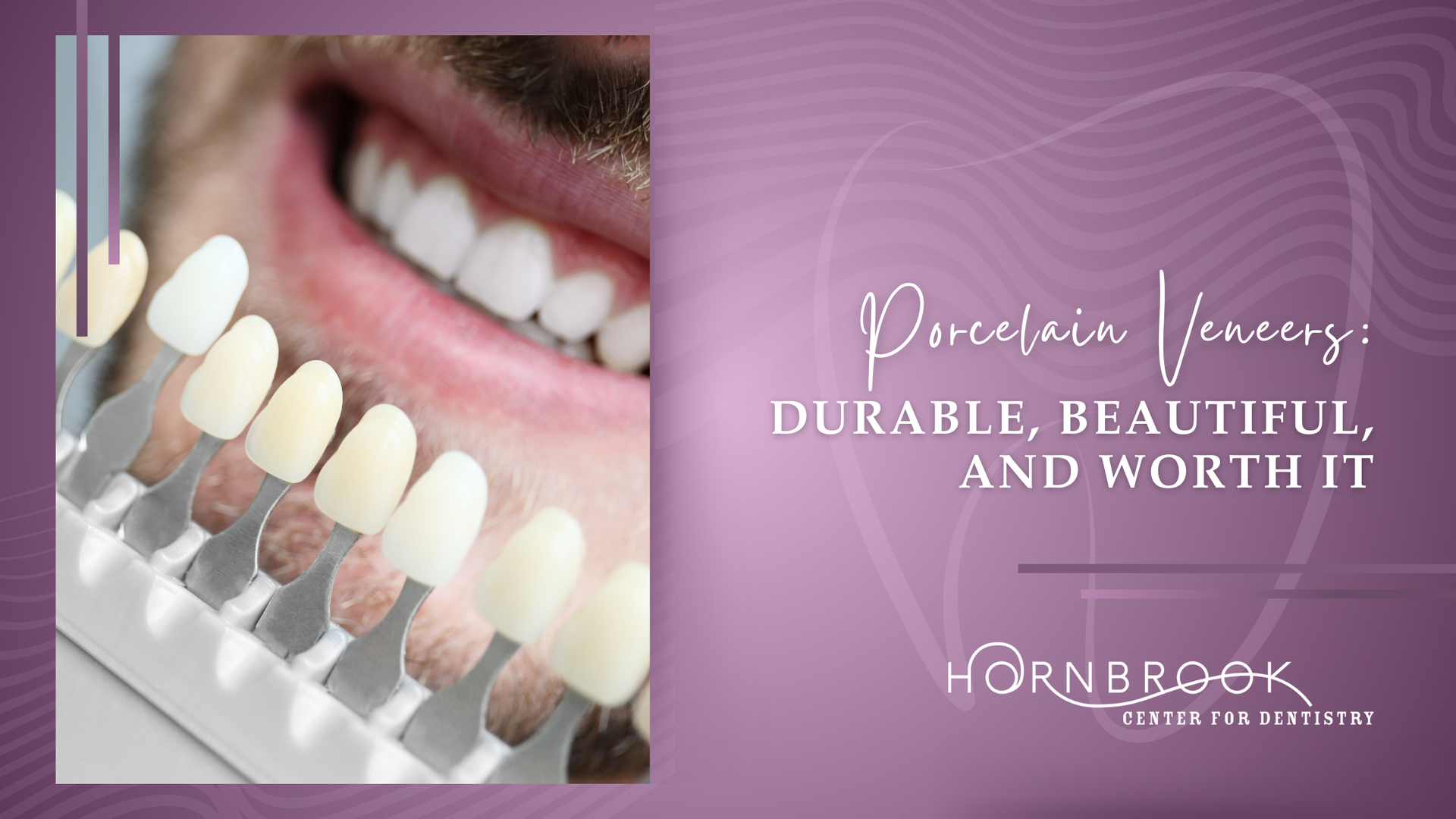 Porcelain veneers are durable , beautiful , and worth it
