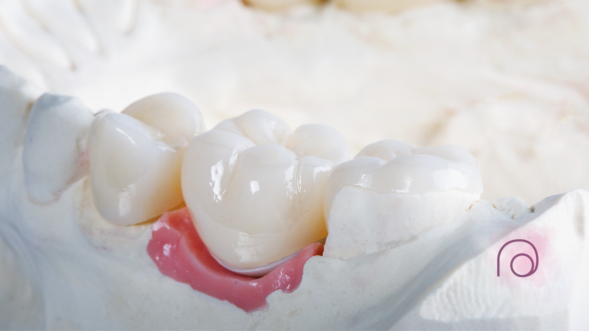 Dental crown model in plaster, with a pink gum line.