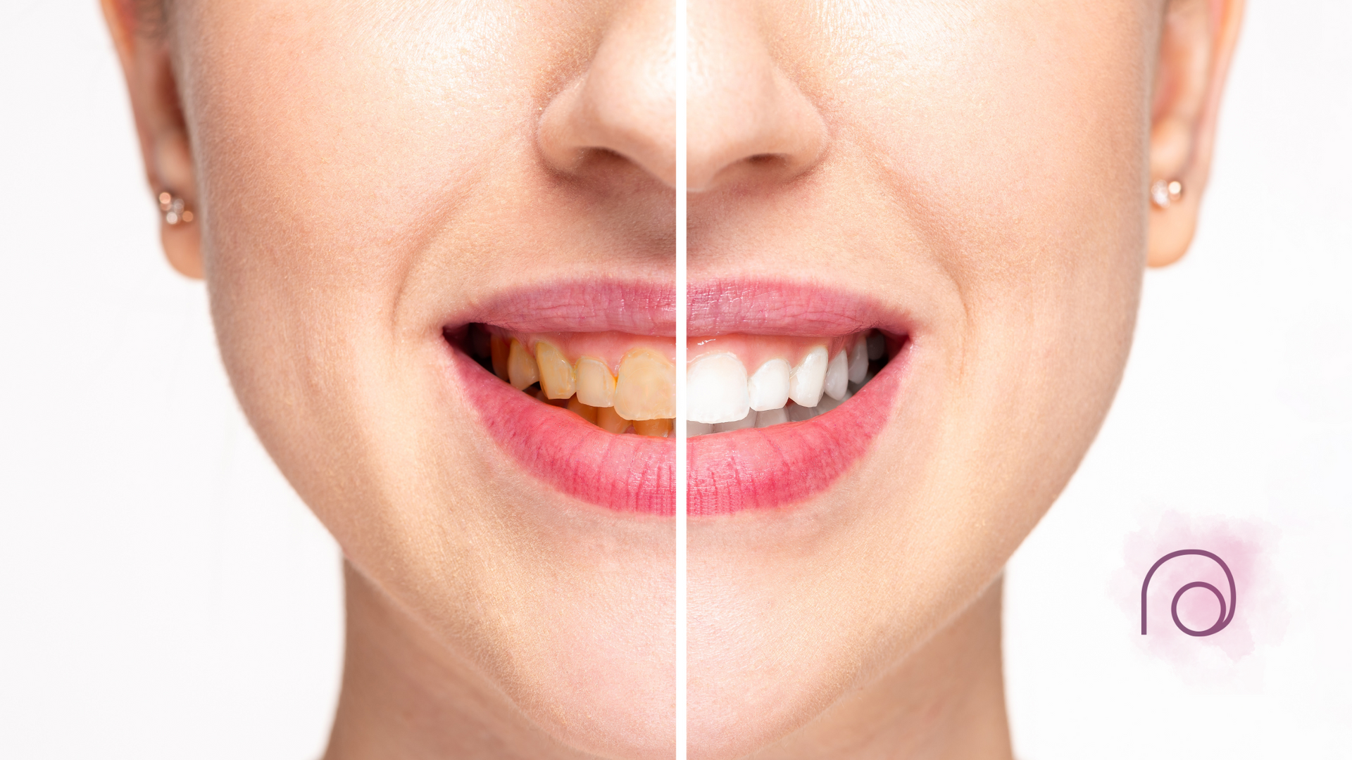 A woman 's teeth before and after whitening.