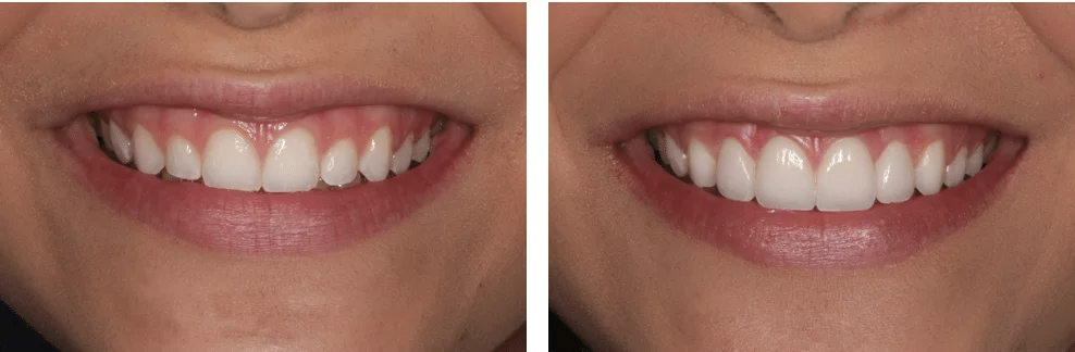 A before and after picture of a woman 's teeth.