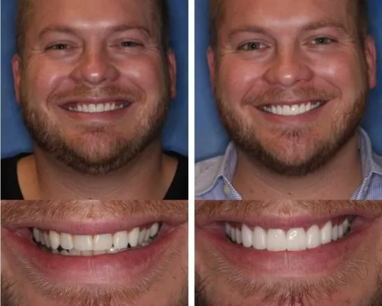 A before and after photo of a man 's smile