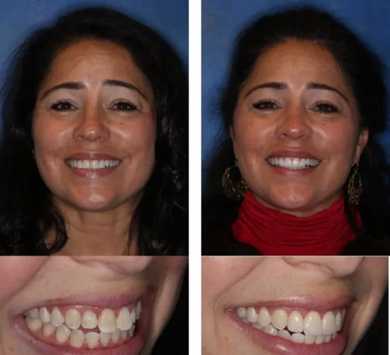 A before and after photo of a woman 's smile