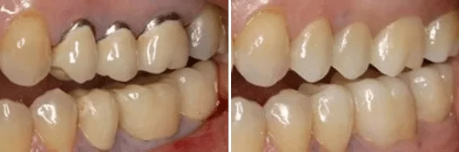 A before and after picture of a person 's teeth.