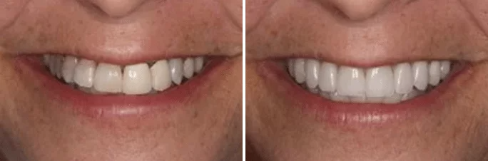 A before and after picture of a woman 's smile.