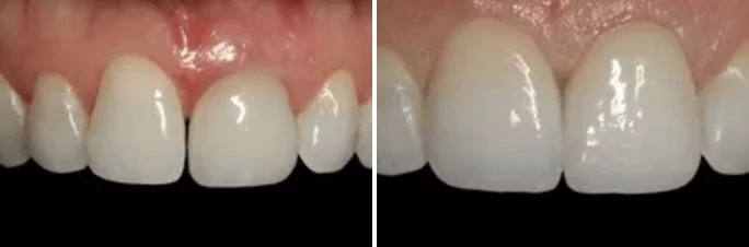 A before and after picture of a person 's teeth.