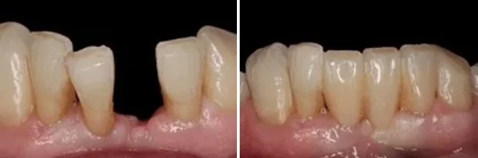 A before and after picture of a person 's teeth.