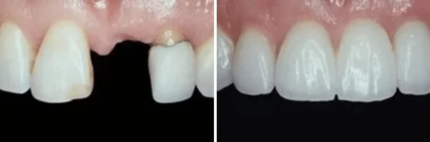 A before and after picture of a person 's teeth with a missing tooth.