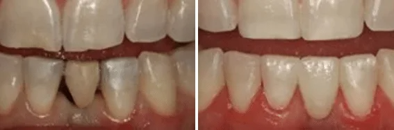 A before and after picture of a person 's teeth.