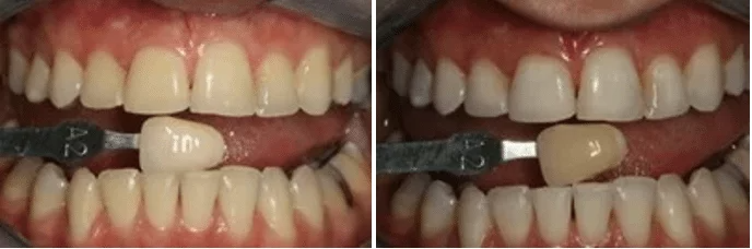 Two pictures of a person 's teeth before and after whitening.